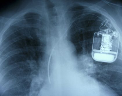 Abbott recalls 350,000 implantable defibrillators to protect against hacks (correction)     - CNET